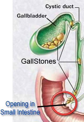 gallbladder stone