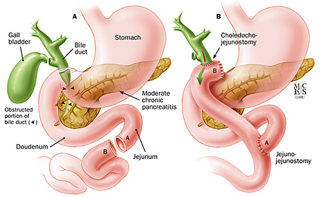 gallbladder stone