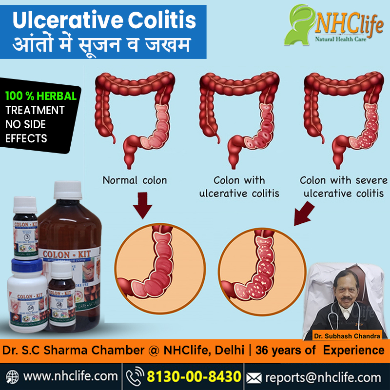 ulcerative colitis