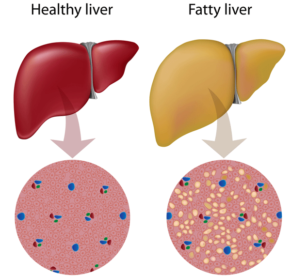 gallbladder stone