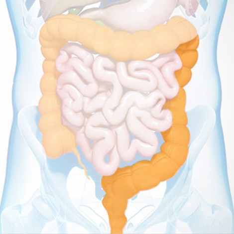 ulcerative colitis