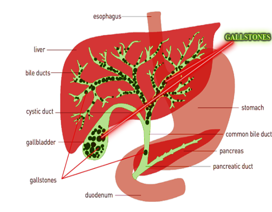 gallbladder stone