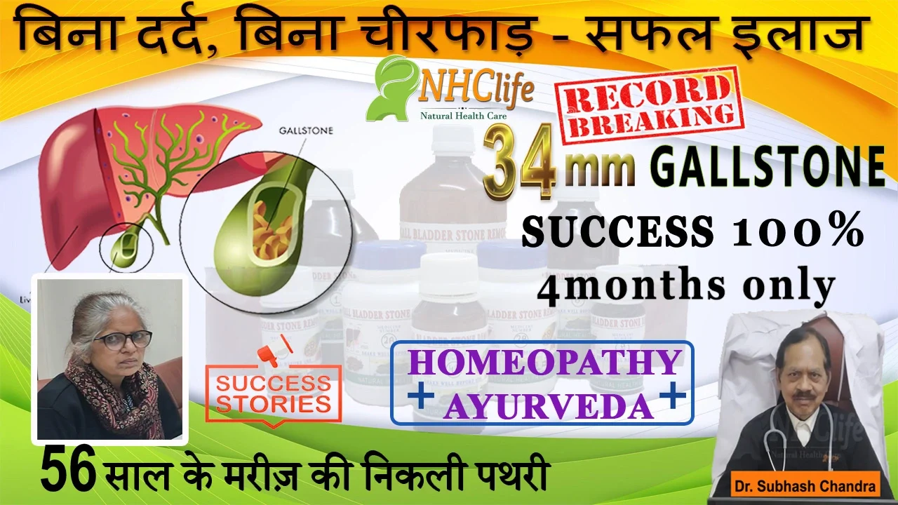 gallbladder stone removed without surgery