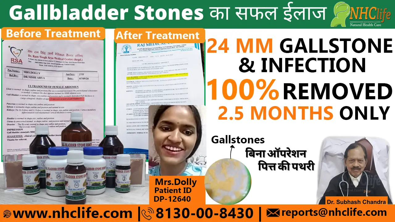 gallbladder stone